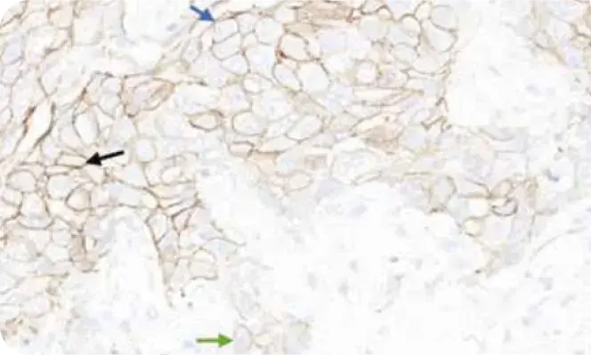 Microscopic image displaying heterogeneous staining during HER2 interpretation. Microscopic image displaying heterogeneous staining during HER2 interpretation.
