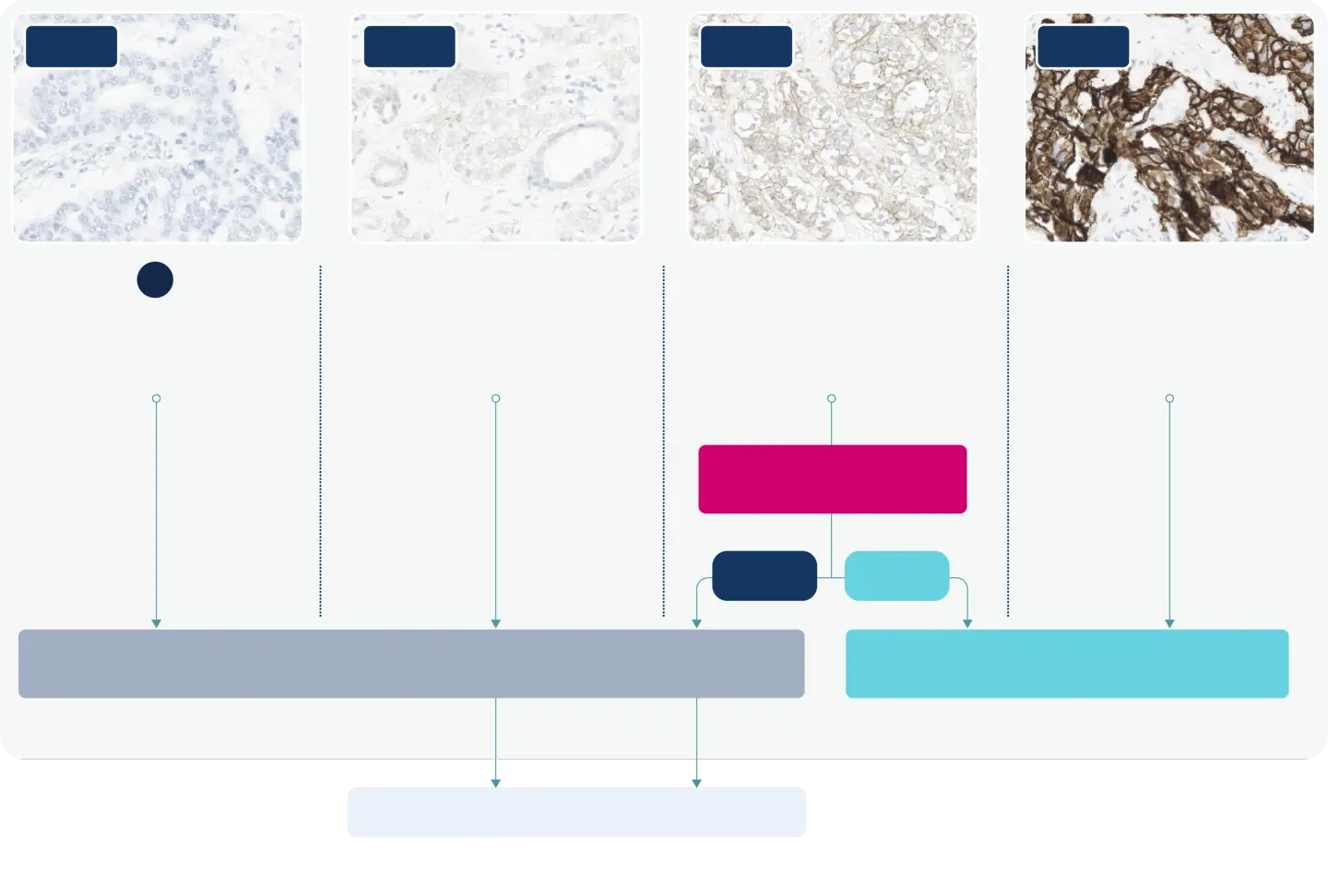 Four slides showing increasing IHC scale from 0 to 3+ and the type of immunohistochemistry staining that may be obtained including: no or incomplete staining in ≤ 10% tumor cells for IHC 0; incomplete membrane staining in >10% tumor cells for IHC 1+; complete membrane staining in >10% tumor cells for IHC 2+; and complete circumferential membrane staining in >10% tumor cells.