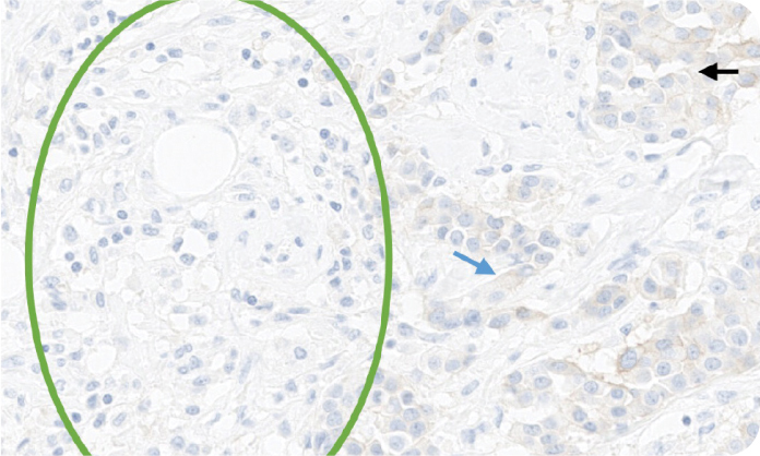 Microscopic image displaying different types of unusual staining patterns during HER2 interpretation. Microscopic image displaying different types of unusual staining patterns during HER2 interpretation.