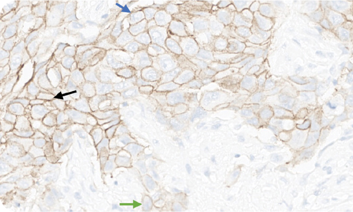 Microscopic image displaying heterogeneous staining during HER2 interpretation. Microscopic image displaying heterogeneous staining during HER2 interpretation.