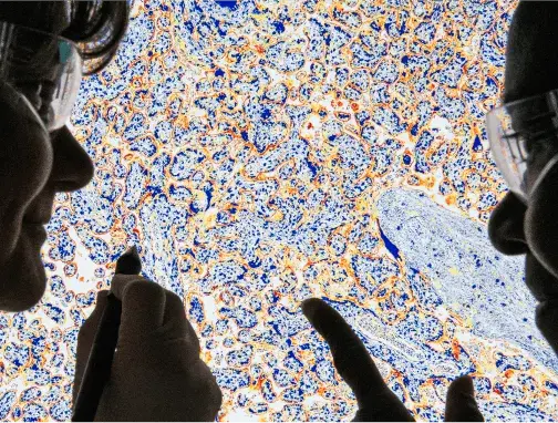 Microscopic slide showing stained cells that are positive for HER2 using immunohistochemistry (IHC) Microscopic slide showing stained cells that are positive for HER2 using immunohistochemistry (IHC)