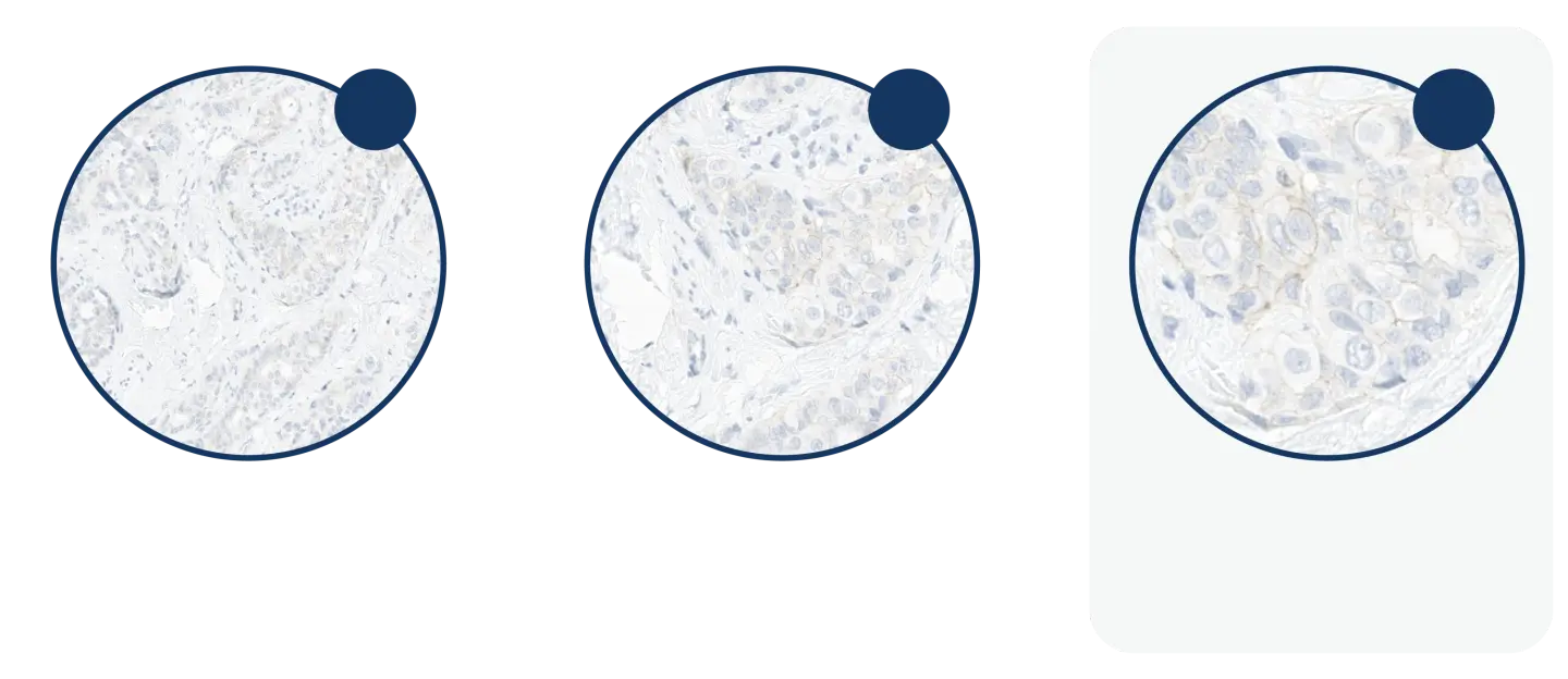 Three microscopic images increasing from 10x to 40x, illustrating the magnification required to discriminate between IHC 0, 1+ and 2+.