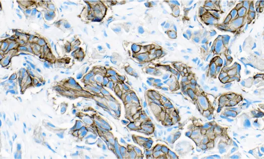 Microscopic slide showing stained cells that are positive for HER2 using immunohistochemistry (IHC) HER2 IHC Educational Resources