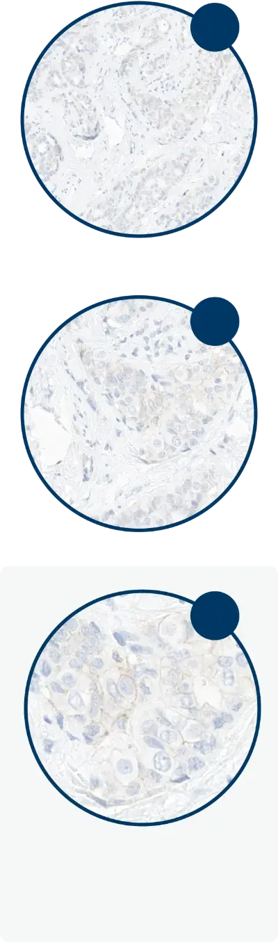Three microscopic images increasing from 10x to 40x, illustrating the magnification required to discriminate between IHC 0, 1+ and 2+.